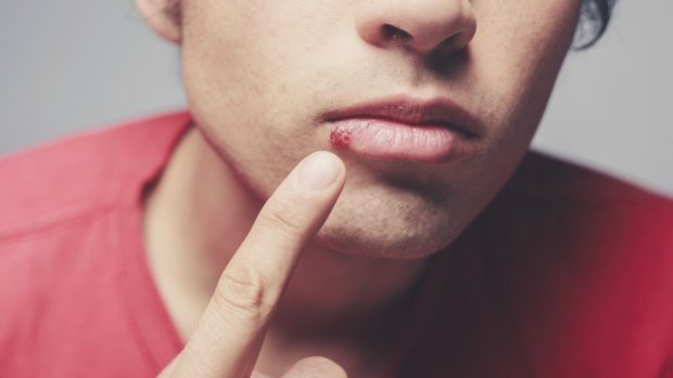 ¿Por qué salen las boqueras y cómo curarlas?